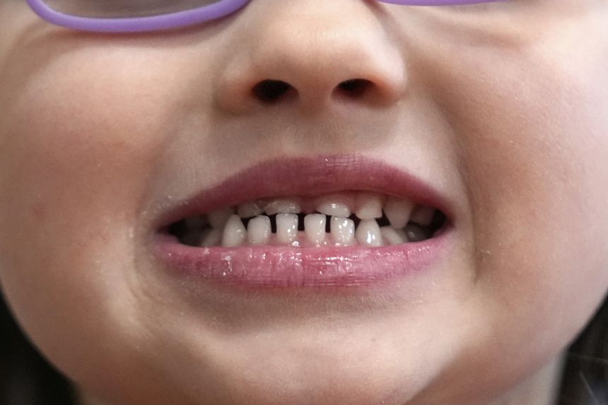 FDA Issues Warnings Over Unapproved Fluoride Products for Children